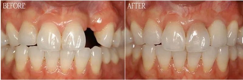 Emergency dental implants, before and after