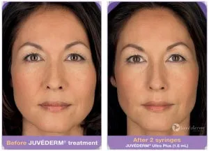 Juvederm before and after treatment